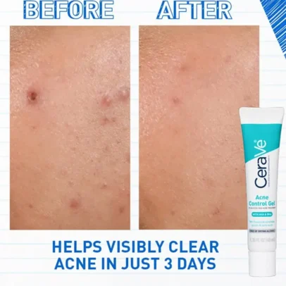 cerave-blemish-control-gel-40ml